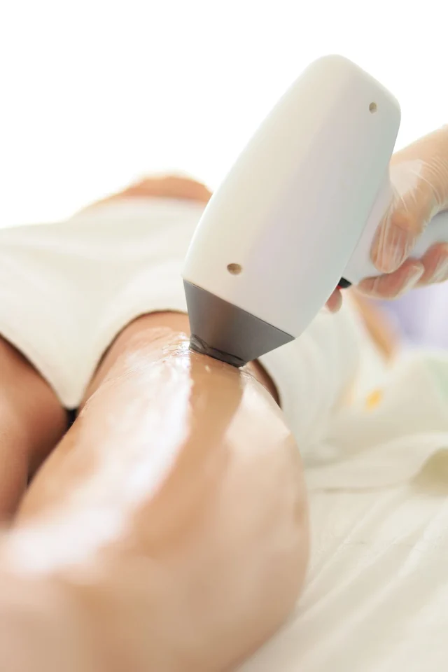 Illustration : une séance d’épilation laser sur une jambe.